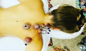 Cupping at Touch Massage & Reiki in Ponte Vedra Beach.